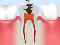 根管治療